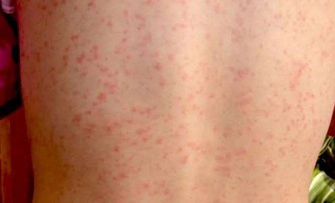 Local health experts are reassuring Cambridgeshire and Peterborough communities that the public health risks from Strep A remain low, despite a higher number of scarlet fever cases already reported this winter. (61231659)