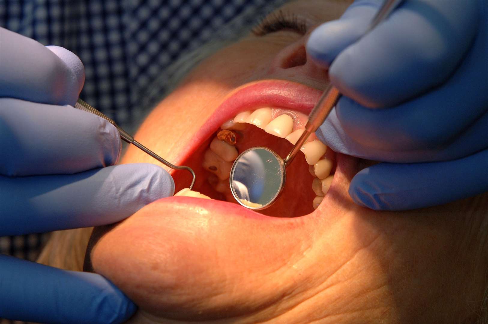 A new report shows thousands denied dental care in Cambridgeshire and it is particularly bad in Wisbech. (6831910)