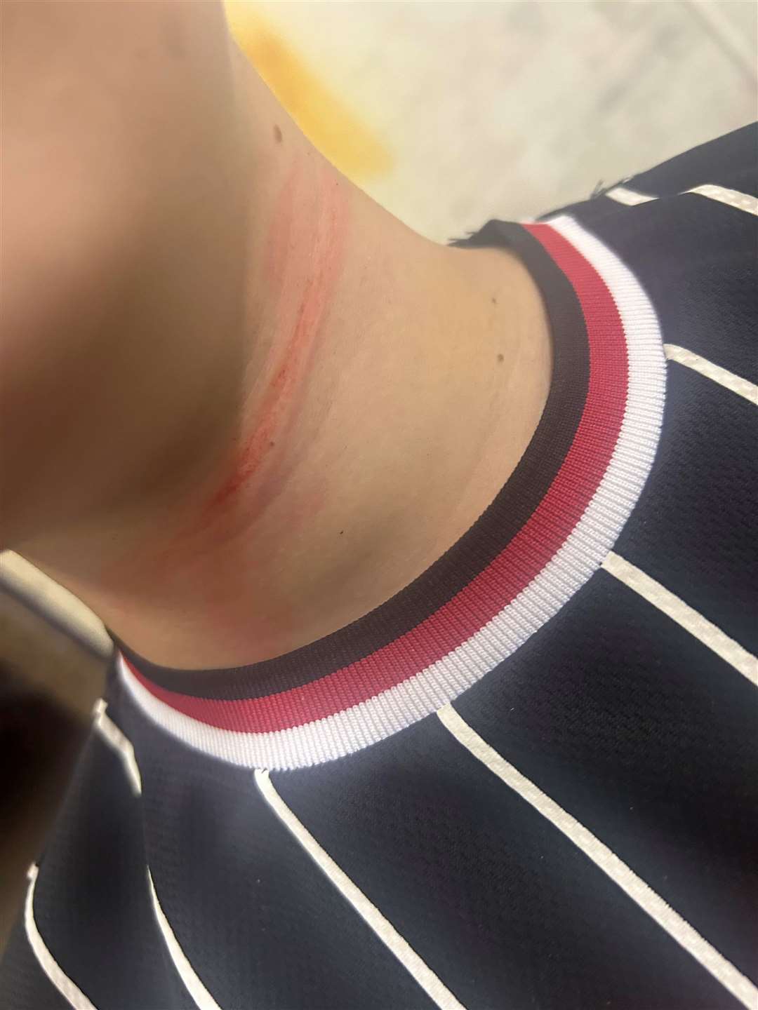 Franki suffered rope like burns to his neck after being caught up in a retractable dog lead.