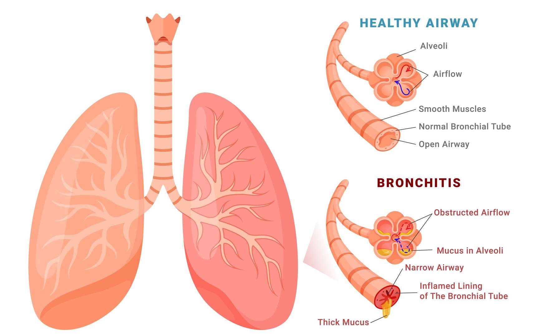 Bronchitis is a respiratory condition characterised by inflammation of the airways in the lungs