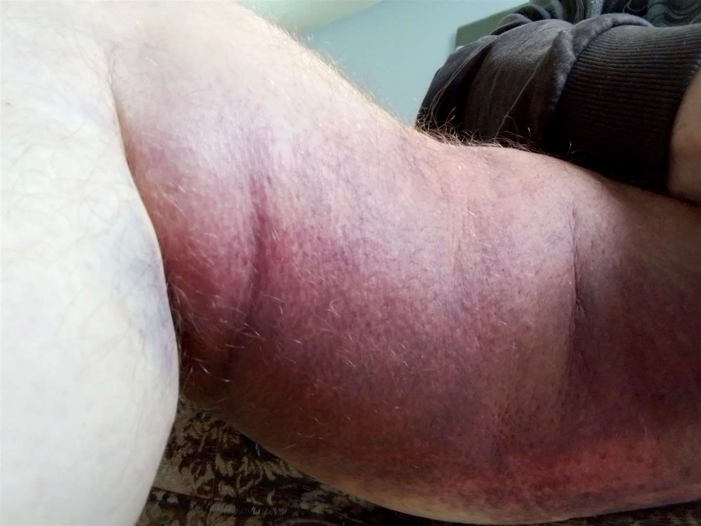 Zbigniew Prokopyszyn from Wisbech has described the agony is suffering after being hit by a lorry on a zebra crossing - he has bruising across his torso, legs and arms.