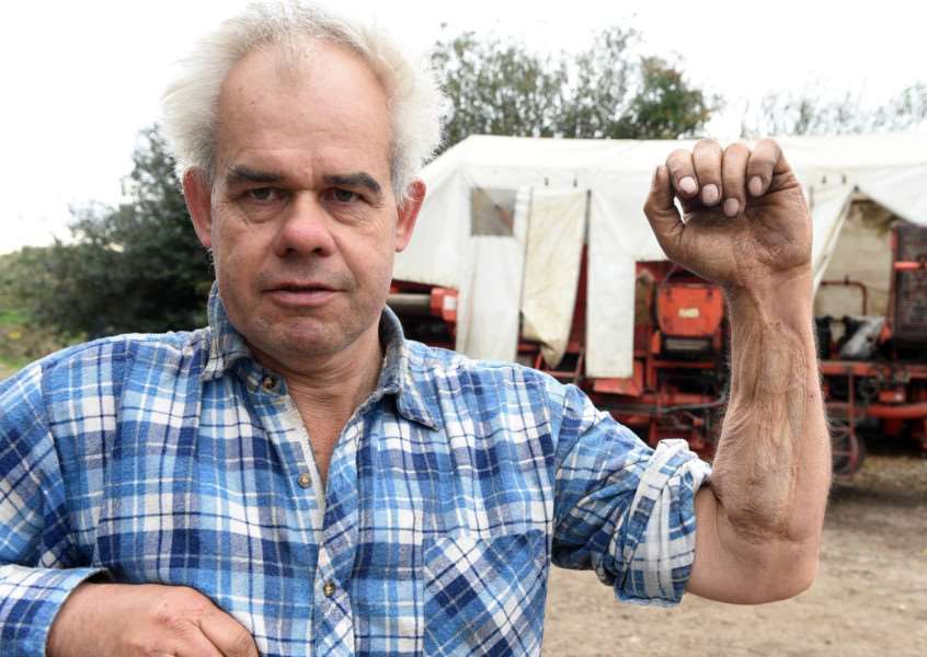 George Munns shows the scar on his arm left after a serious farming accident involving the potato harvester pictured behind him.