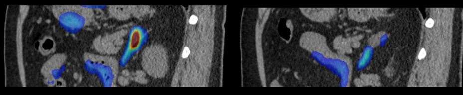 2D PET scan images before and after Triple T - On the left, before Triple T where the nodule in the adrenal gland appears as a red-brown spot. On the right, after Triple T where the nodule has been destroyed. Picture: Cambridge University Hospitals