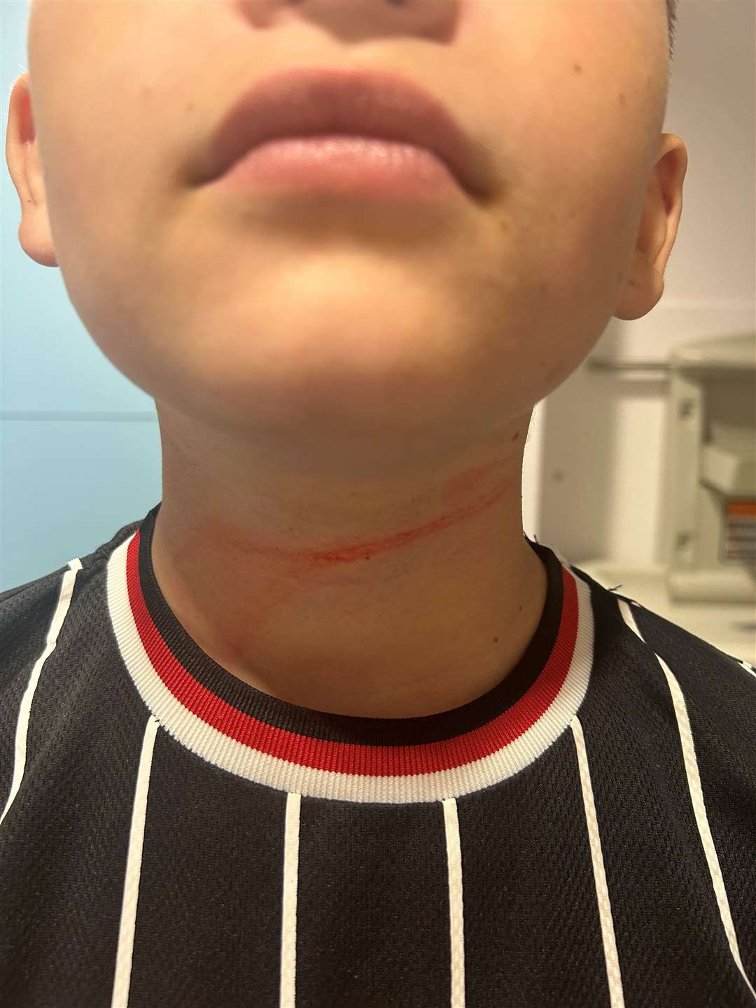 Franki suffered rope like burns to his neck after being caught up in a retractable dog lead.
