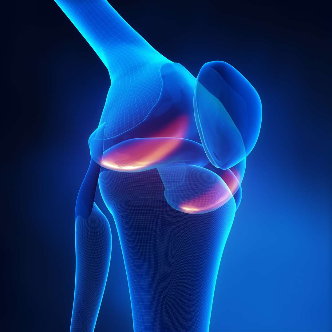 Knee Arthritis in x-ray view. (53922383)