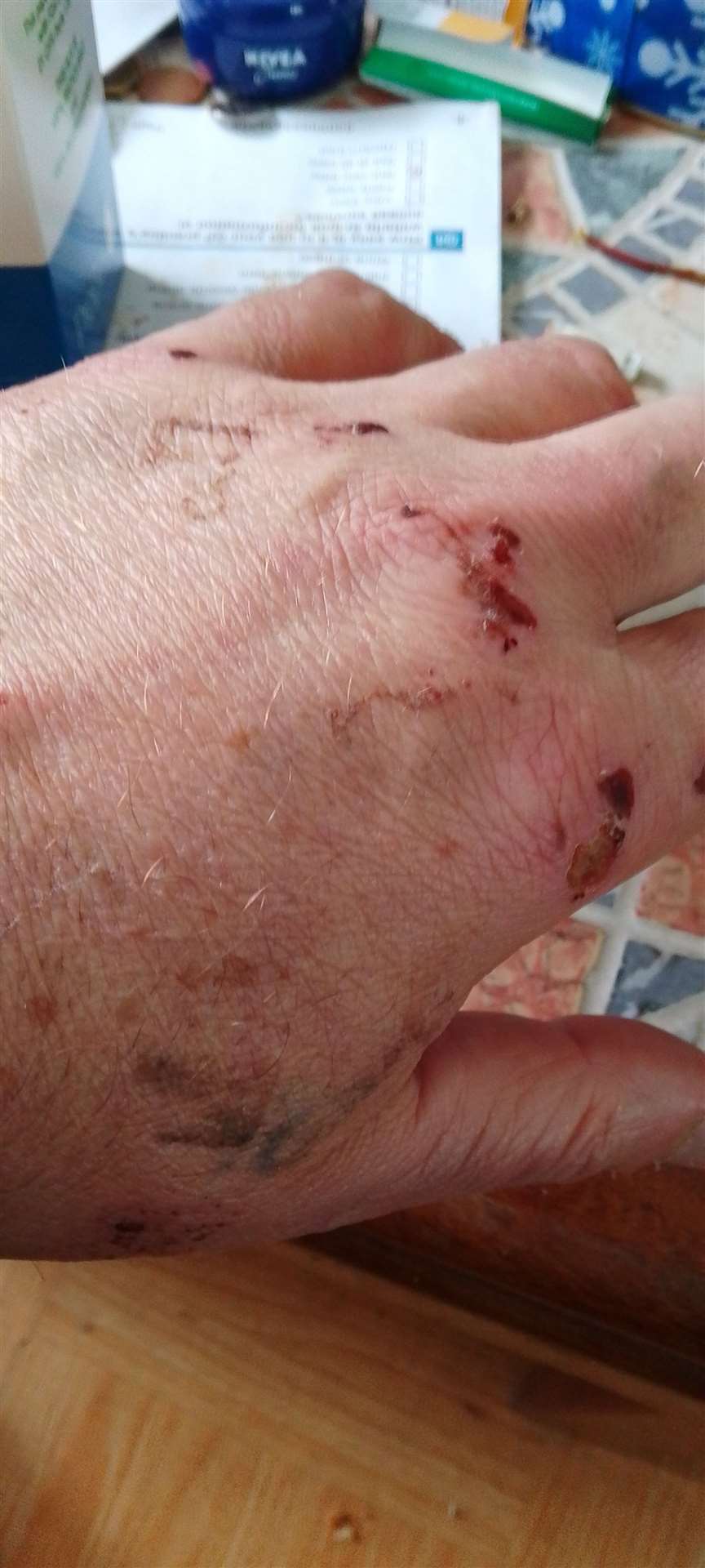 Zbigniew Prokopyszyn from Wisbech has described the agony is suffering after being hit by a lorry on a zebra crossing. (63031312)