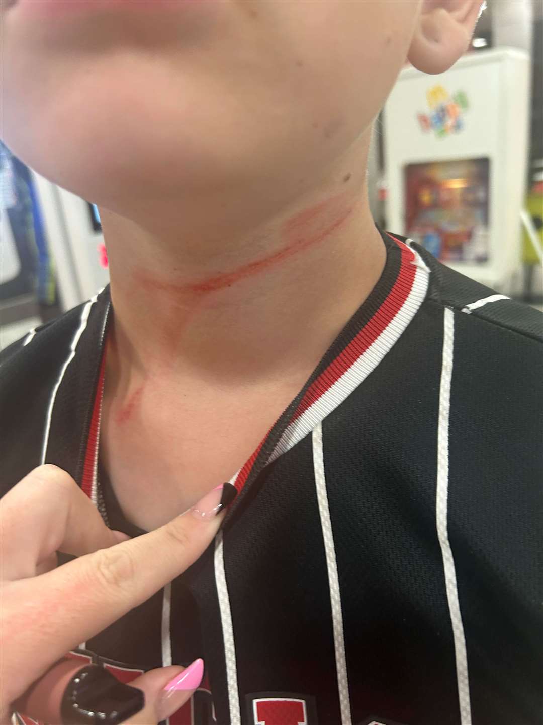 Franki suffered rope like burns to his neck after being caught up in a retractable dog lead.