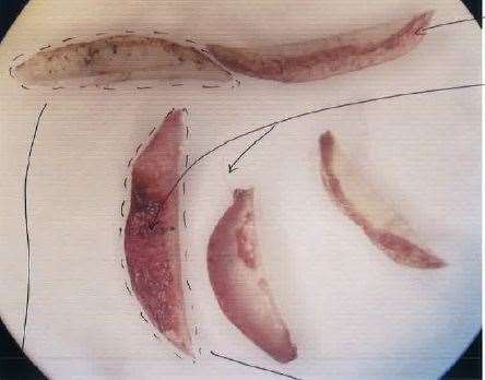 Fingernails from the right hand of Una Crown, where Newton’s DNA was found